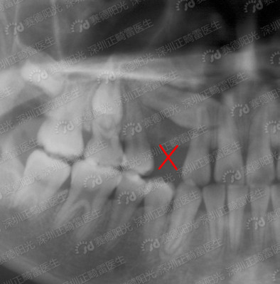 乳牙早失，恒牙失去引导导致萌出方向异常.jpg