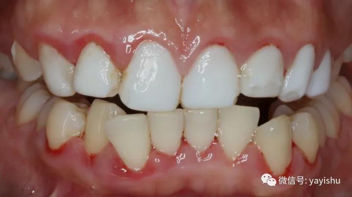 纳米炫齿浮雕牙齿修复对比