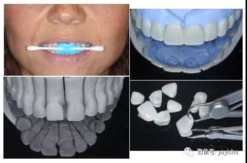 牙齿美学修复步骤