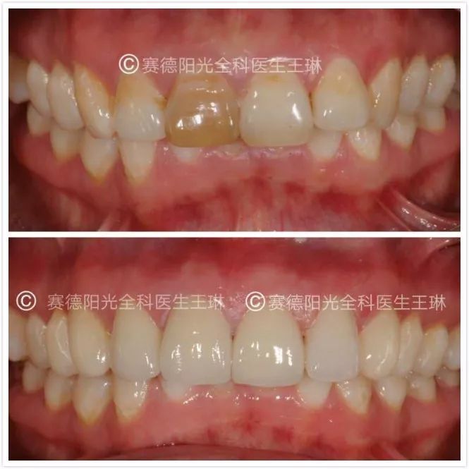 赛德阳光口腔 全科医生 王琳美学修复专场 活动 美学修复前后对比图 赛德阳光口腔 全科医生 王琳美学修复专场 活动 美学修复前后对比图
