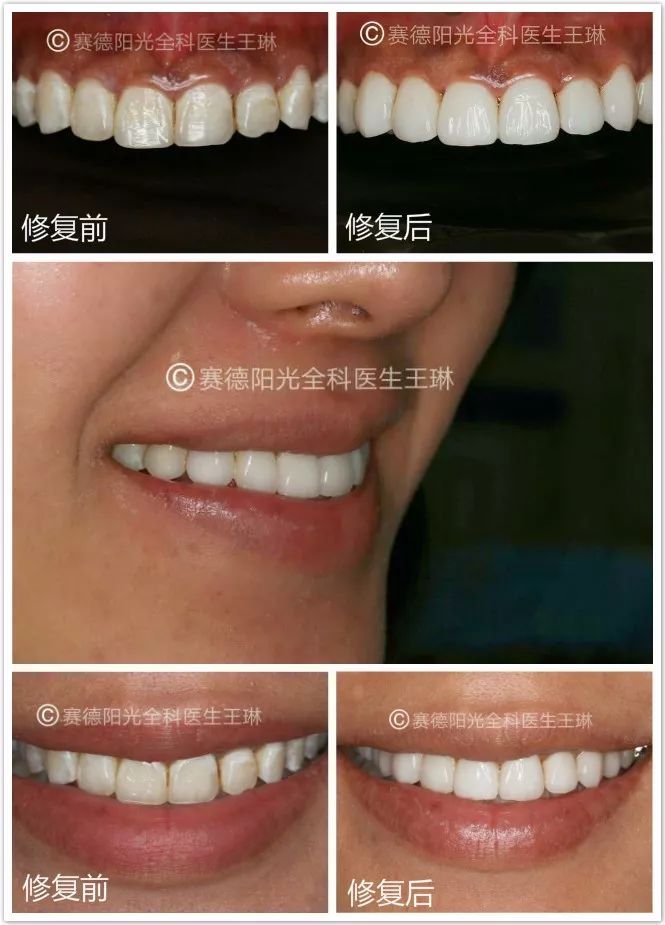 赛德阳光口腔 全科医生 王琳美学修复专场 活动 美学修复前后对比图 赛德阳光口腔 全科医生 王琳美学修复专场 活动 美学修复前后对比图