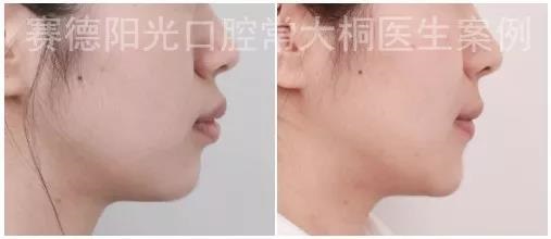 常大桐大夫牙性矫正案例