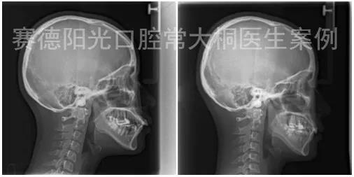 常大桐大夫牙性矫正案例