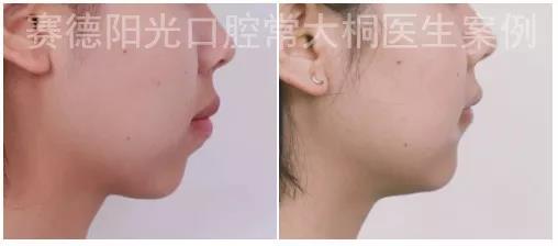 常大桐大夫牙性矫正案例