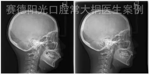 常大桐大夫牙性矫正案例