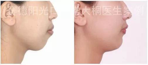 常大桐大夫骨性矫正案例