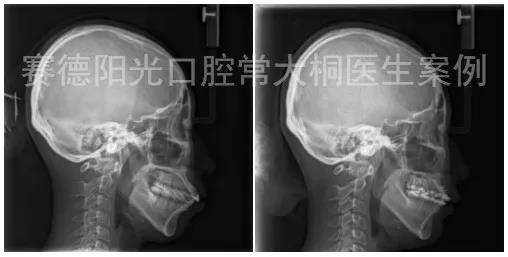 常大桐大夫骨性矫正案例