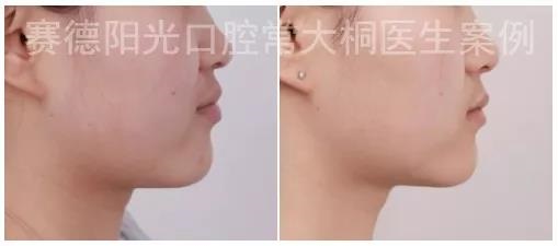 常大桐大夫骨性矫正案例