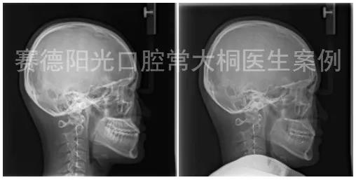 常大桐大夫骨性矫正案例