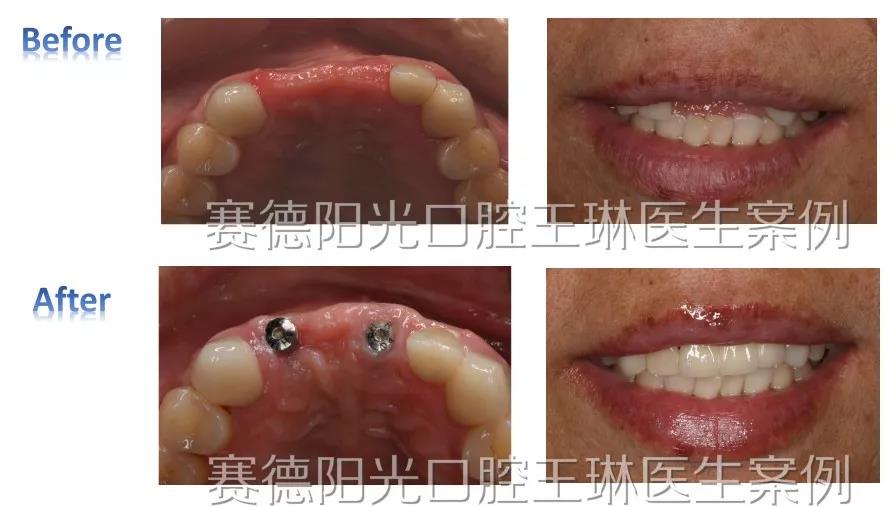 王琳医生种植牙案例