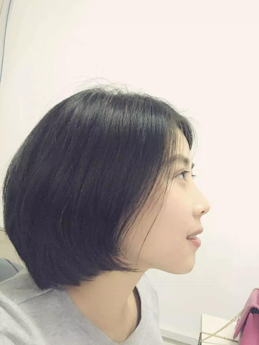 Mindy:再看以前的旧照片,确实很土,矫正后也好看多了,尤其是鼻子下面部分变化真的很大。