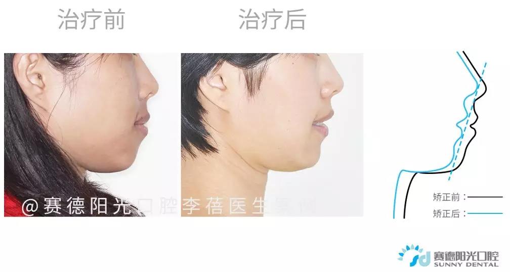 矫正前后侧貌对比