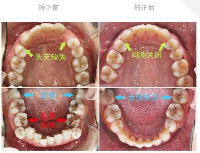 矫正前后口内像对比