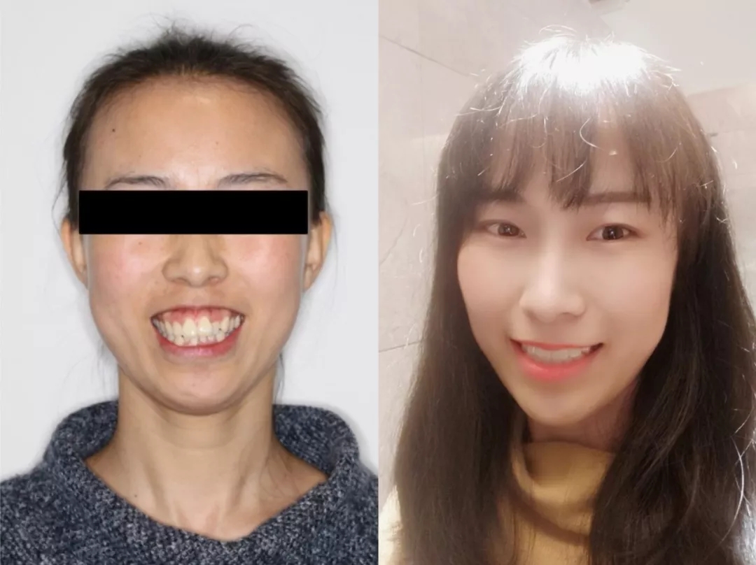一定要去矫正牙齿