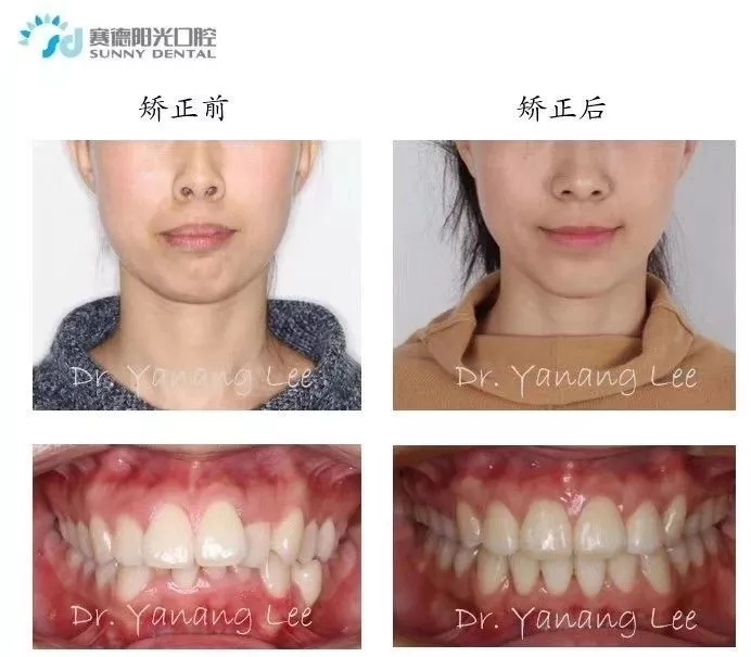 关于我的矫正方案