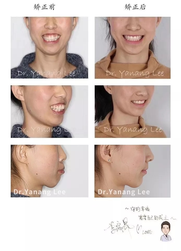 脸型美观协调了不少!