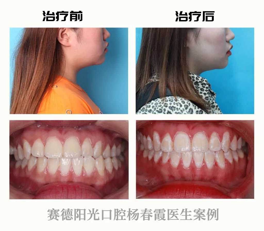 杨春霞医生正畸案例