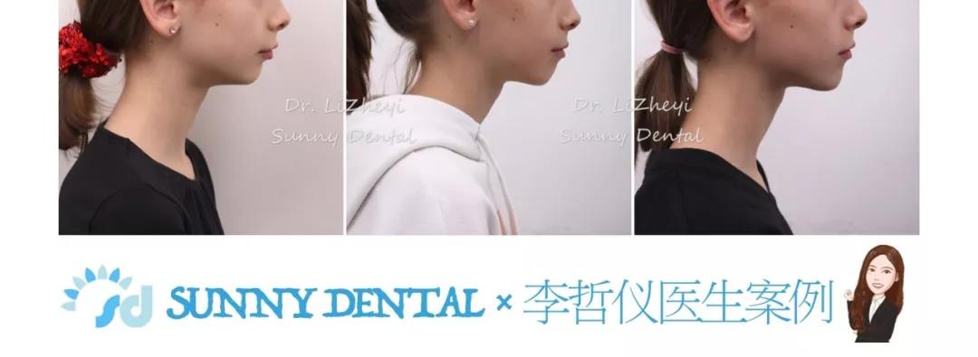 下颌后缩矫正