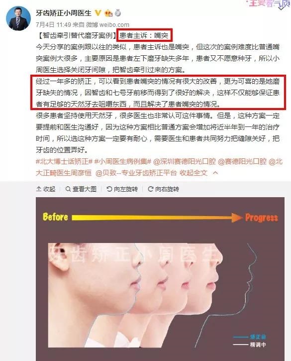 周绍楠牙齿矫正提升侧颜案例集