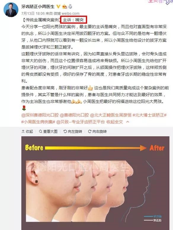 周绍楠牙齿矫正提升侧颜案例集