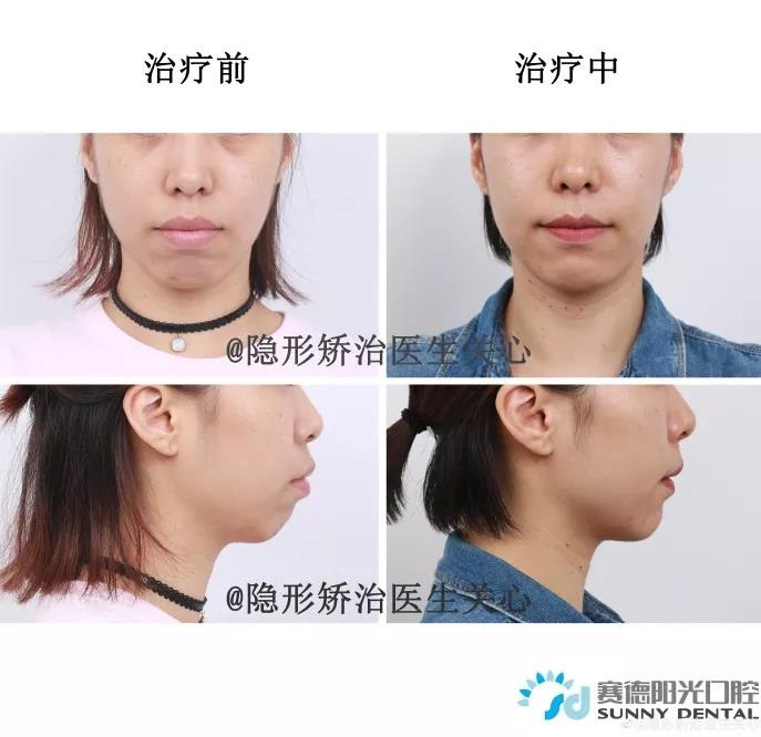 关心医生隐适美矫正案例