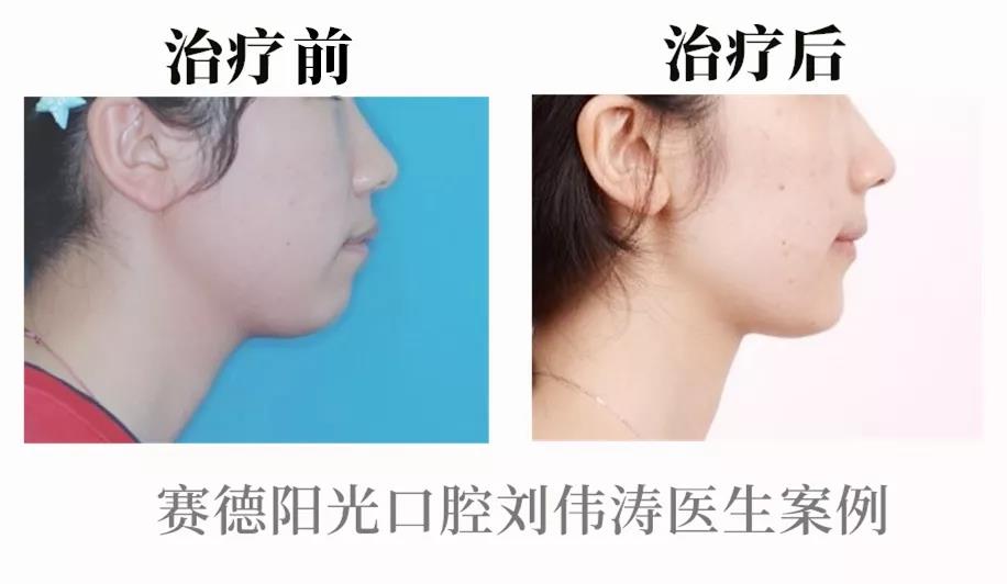 刘伟涛医生正畸案例