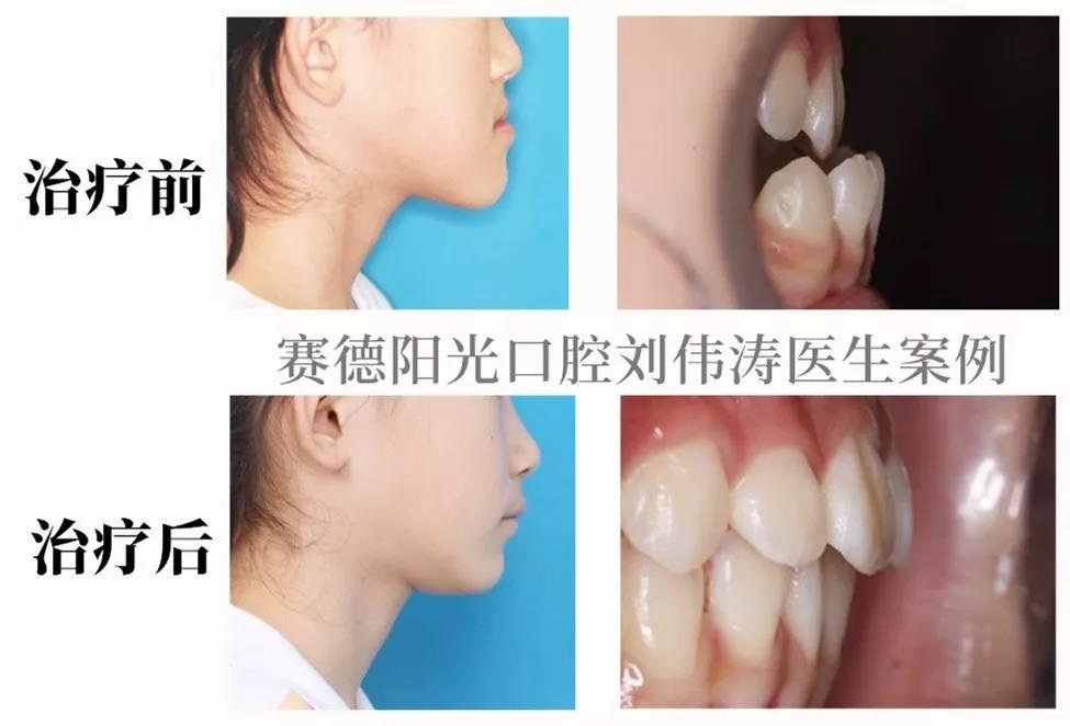刘伟涛医生正畸案例