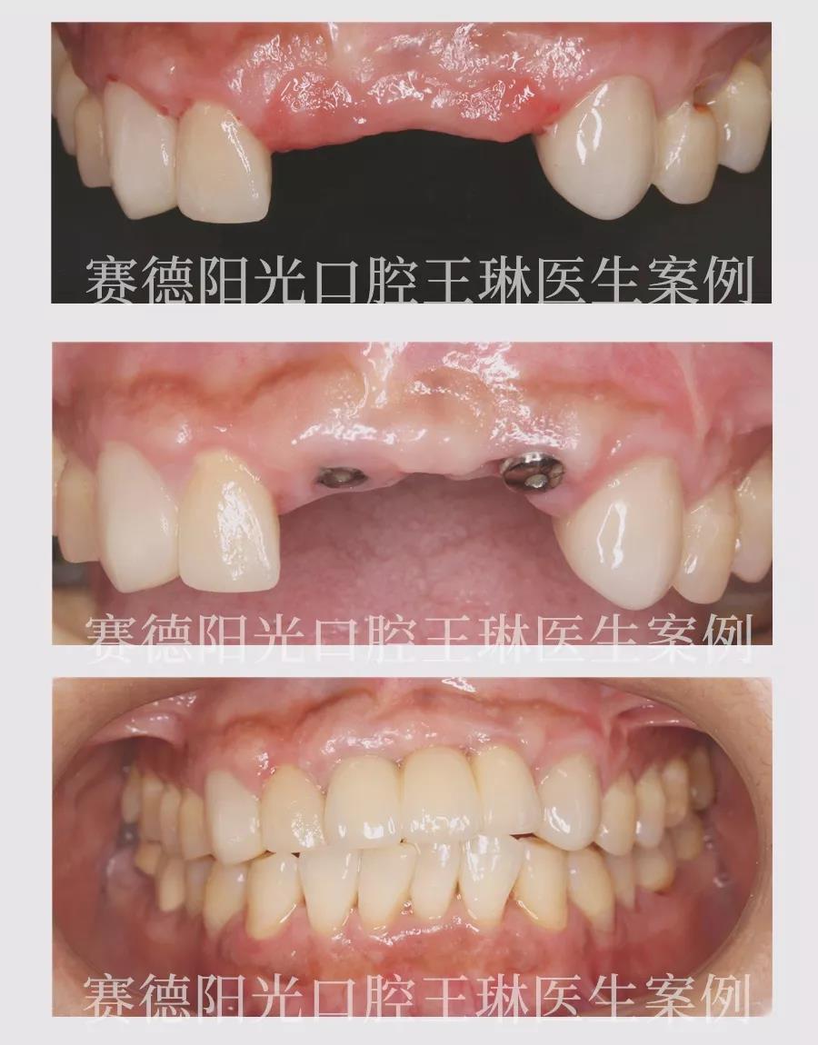 赛德阳光口腔王琳医生 种植牙案例