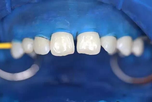 橡皮障在口腔的临床应用