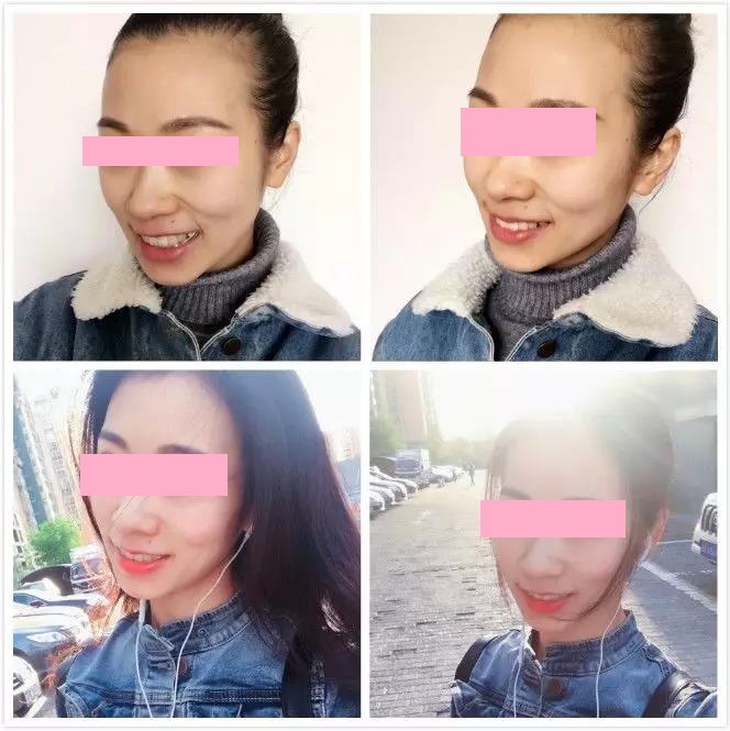 首先选择隐适美的隐形牙套是因为不影响美观