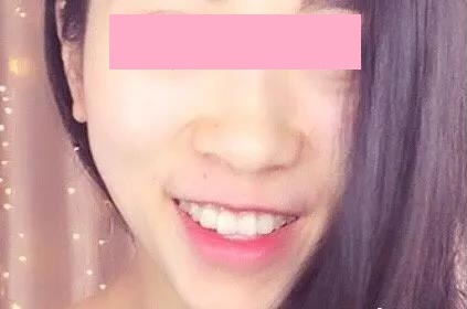 看得见的笑容,看不到的牙套