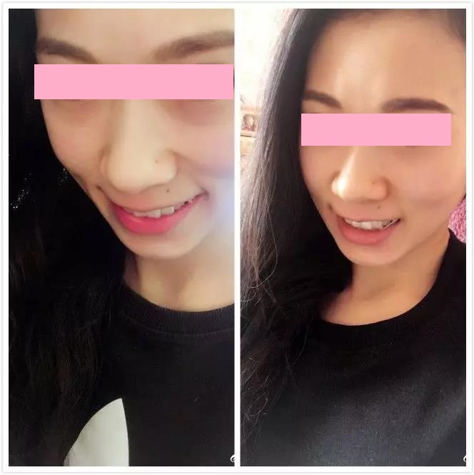 右图嘴里的橡皮筋很明显