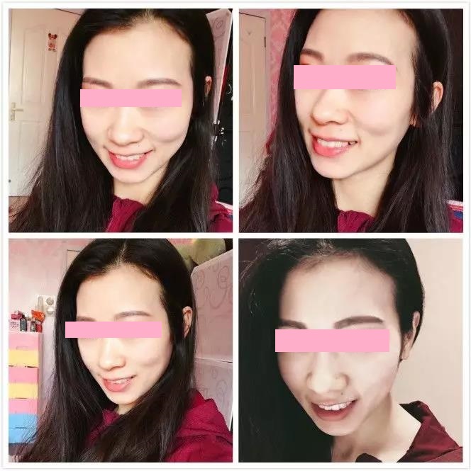 就这样一天天的戴牙套,牙齿一天天的变化