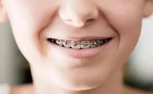 咧嘴笑不仅是开心的表达，更是一种“炫耀”牙套的最好方式了。