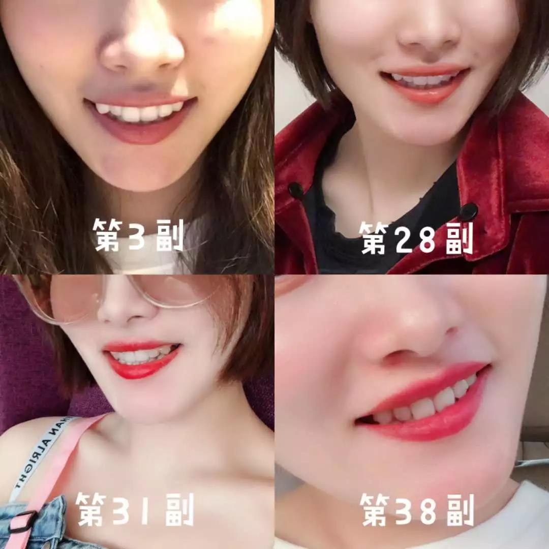 我一共要戴56副牙套,现在已经戴到41副啦!而且听周博说还能提前进入精调期