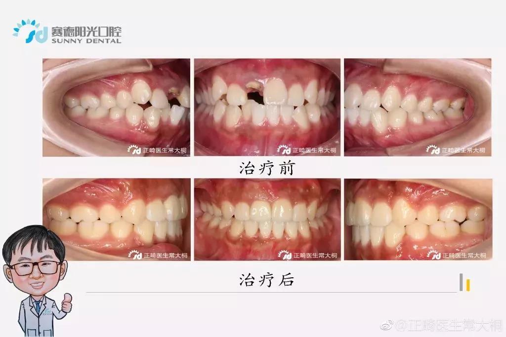 常大桐医生正畸案例