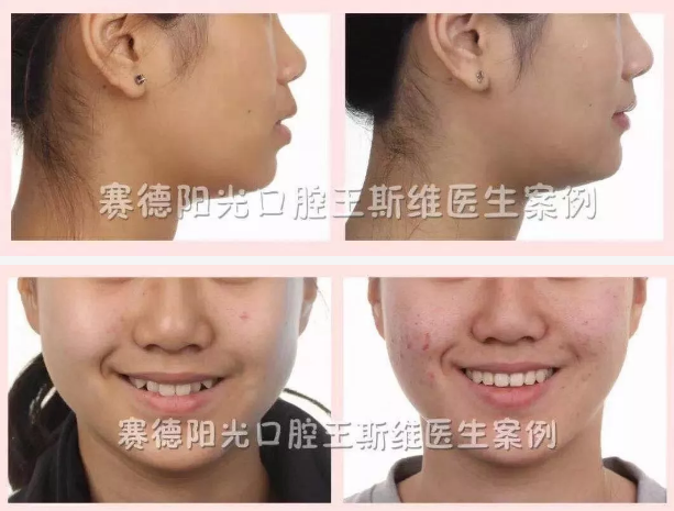 王斯维医生正畸案例