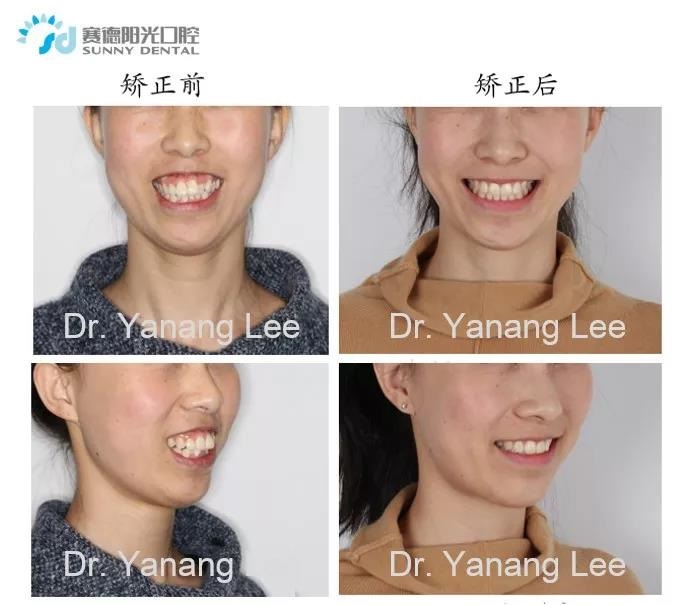 李彦昂主任的 单纯正畸露龈笑矫正案例