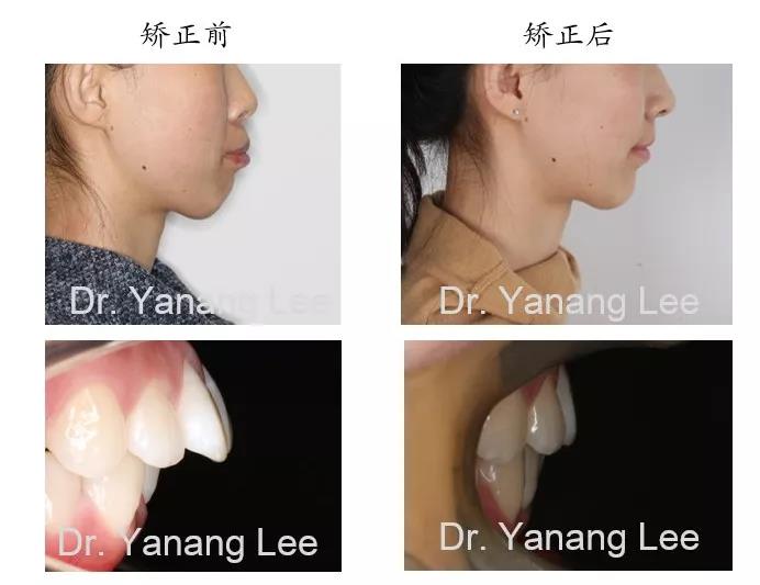 李彦昂主任的 单纯正畸露龈笑矫正案例
