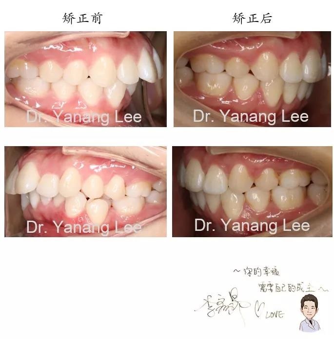 李彦昂主任的 单纯正畸露龈笑矫正案例