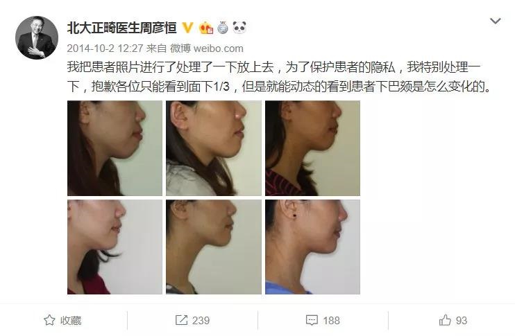 周彦恒教授正畸案例