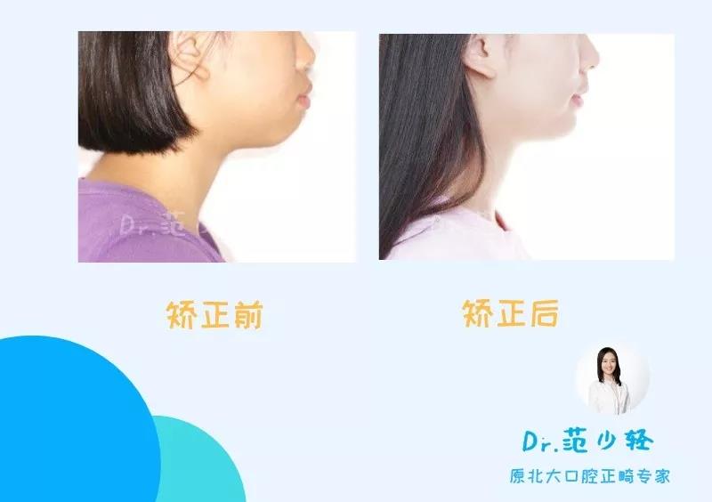 范少轻医生正畸案例