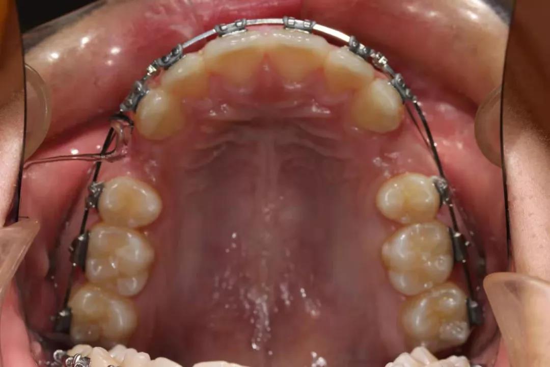 拔牙矫正治疗牙齿前突为例