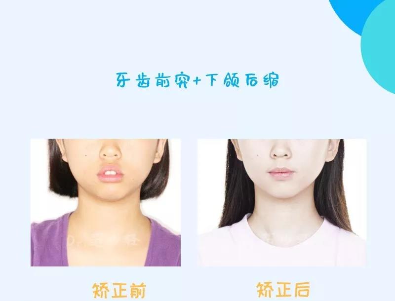 范少轻医生正畸案例