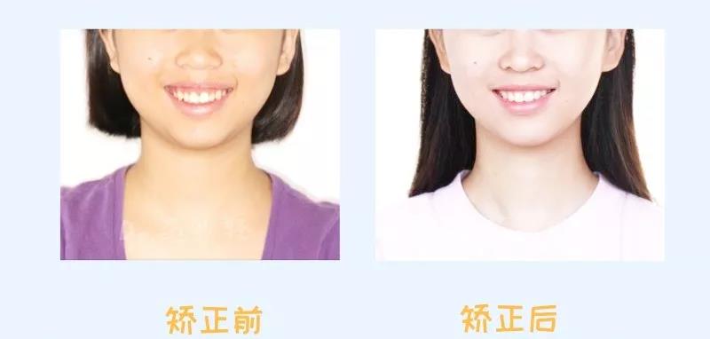 范少轻医生正畸案例