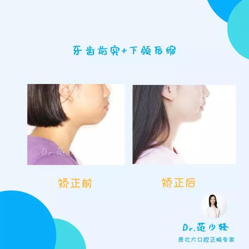 范少轻医生龅牙牙齿矫正案例