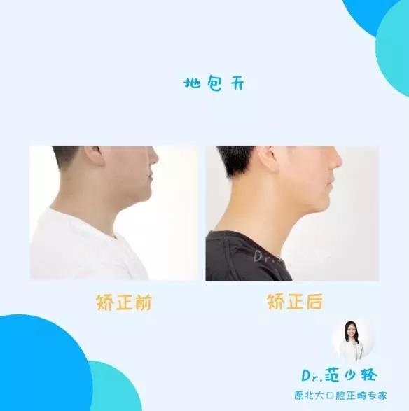 北大口腔范少轻医生地包天牙齿矫正案例