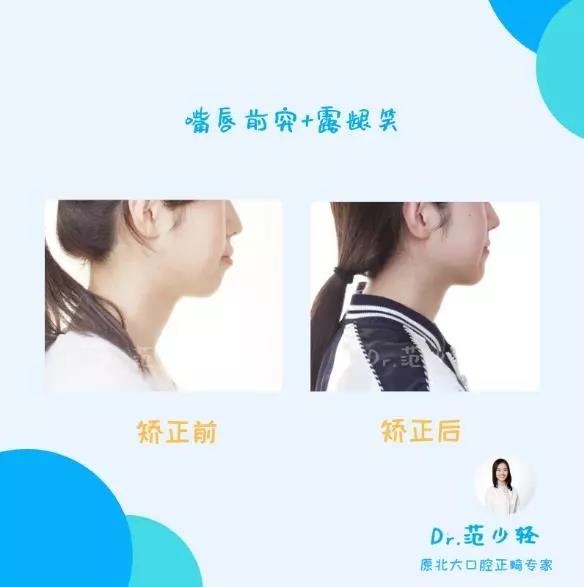 北大口腔范少轻医生露牙龈牙齿矫正案例