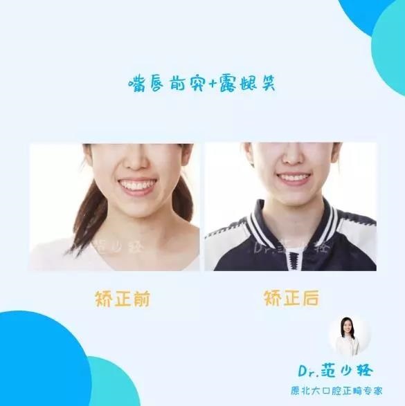 北大口腔范少轻医生露牙龈牙齿矫正案例