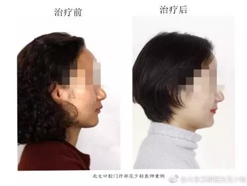 北大口腔范少轻医生牙齿矫正案例